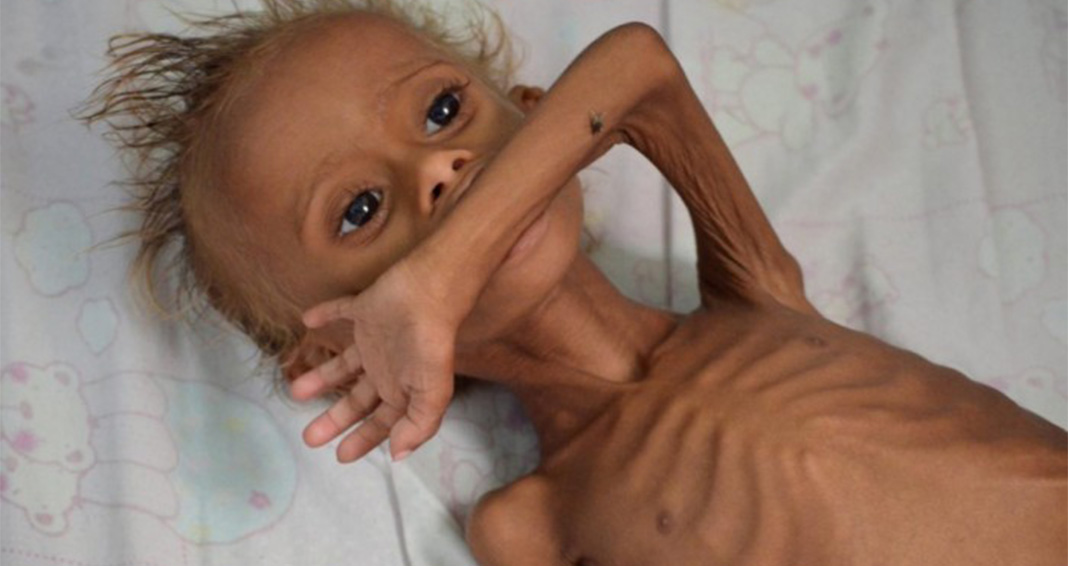 KIU International Desk: COVID-19 to Jeopardize Food Security and Cause Malnutrition in Africa